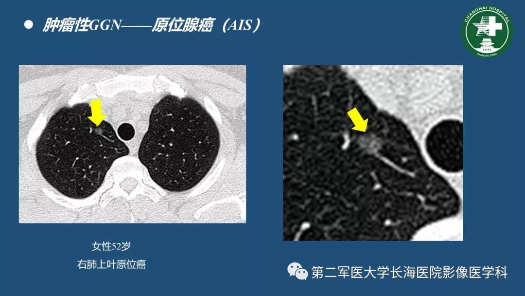 影像PPT - 【PPT】肺磨玻璃密度影的诊断及鉴别-25