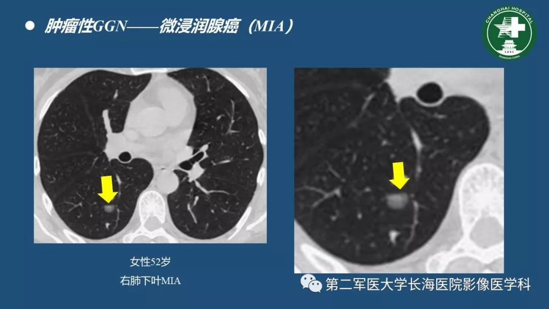 影像PPT - 【PPT】肺磨玻璃密度影的诊断及鉴别-27
