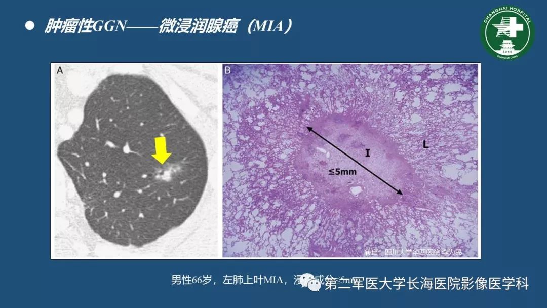 影像PPT - 【PPT】肺磨玻璃密度影的诊断及鉴别-28