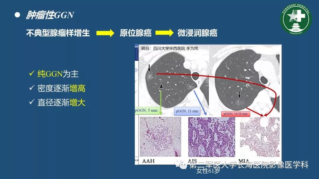 影像PPT - 【PPT】肺磨玻璃密度影的诊断及鉴别-29