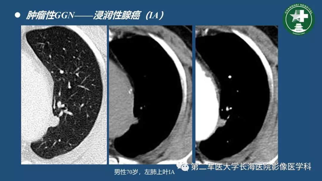 影像PPT - 【PPT】肺磨玻璃密度影的诊断及鉴别-31