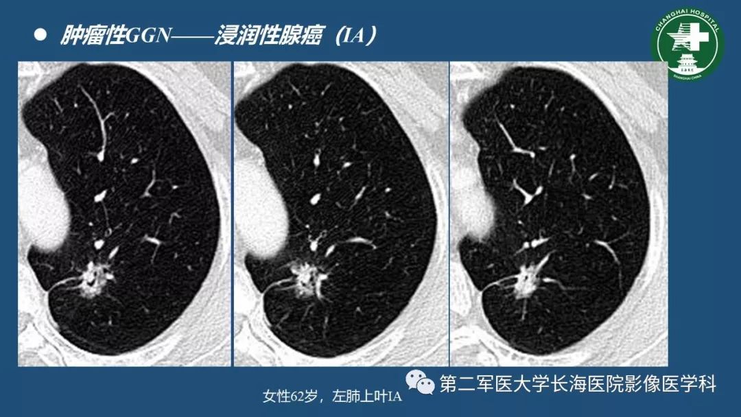 影像PPT - 【PPT】肺磨玻璃密度影的诊断及鉴别-32