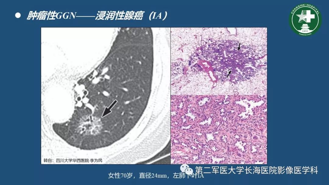 影像PPT - 【PPT】肺磨玻璃密度影的诊断及鉴别-33