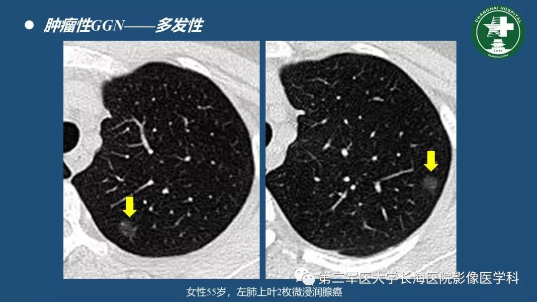 影像PPT - 【PPT】肺磨玻璃密度影的诊断及鉴别-35