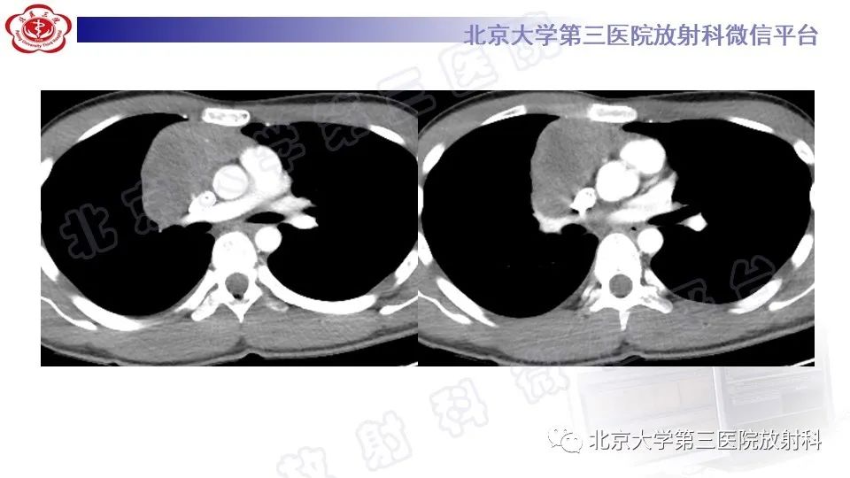 原发性纵隔胚胎性癌-4