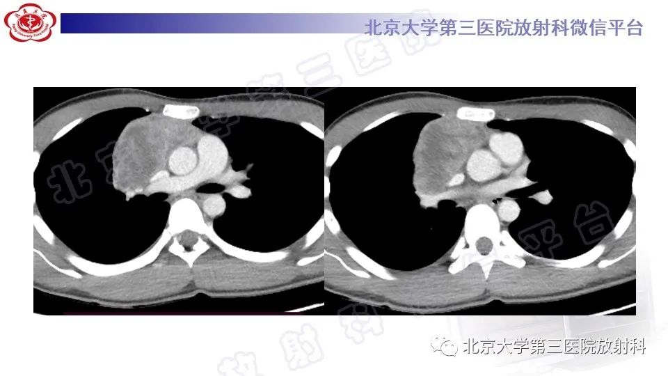 原发性纵隔胚胎性癌-5