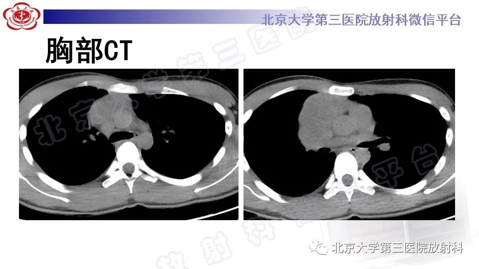 原发性纵隔胚胎性癌-3