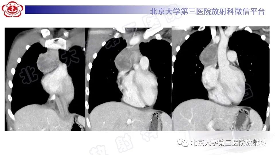原发性纵隔胚胎性癌-7