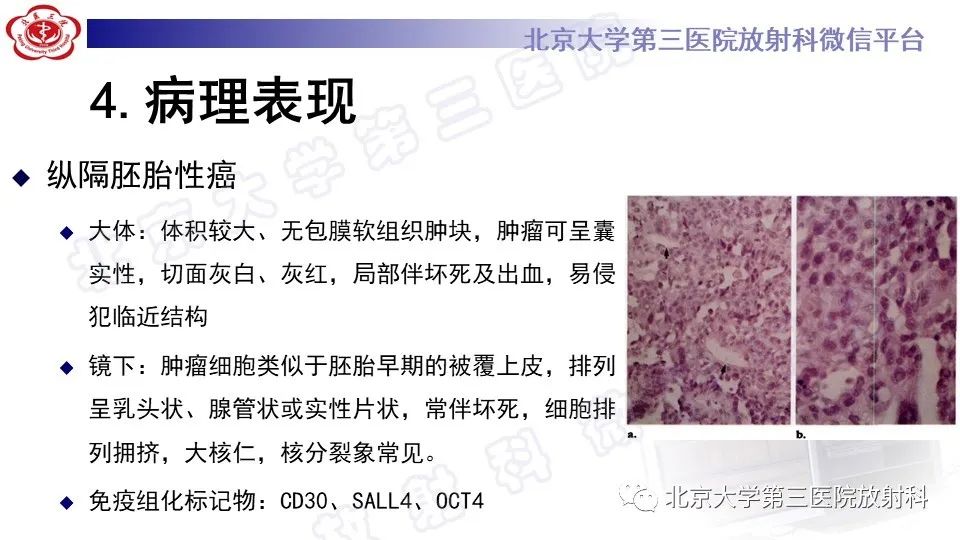 原发性纵隔胚胎性癌-17