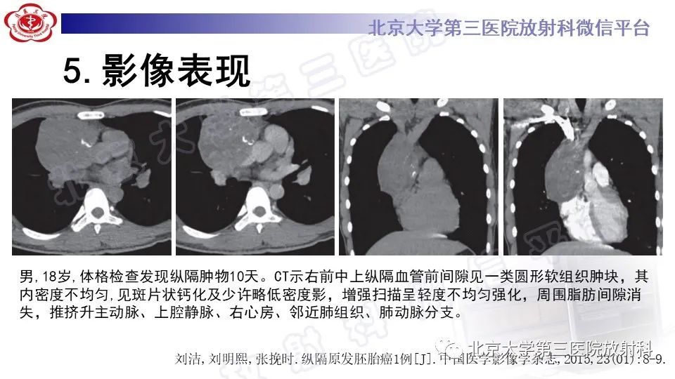 原发性纵隔胚胎性癌-19