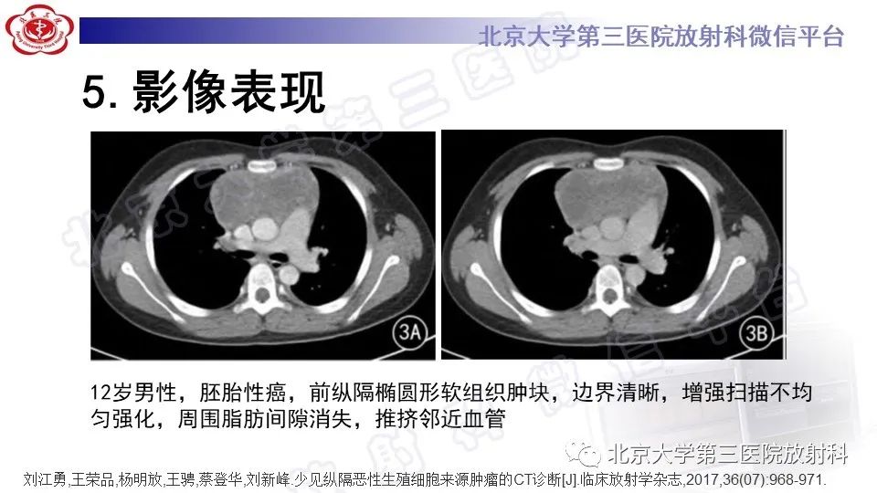 原发性纵隔胚胎性癌-20