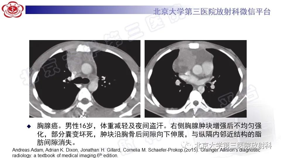 原发性纵隔胚胎性癌-27
