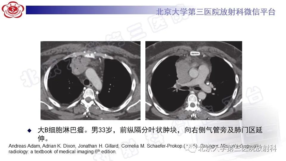 原发性纵隔胚胎性癌-29
