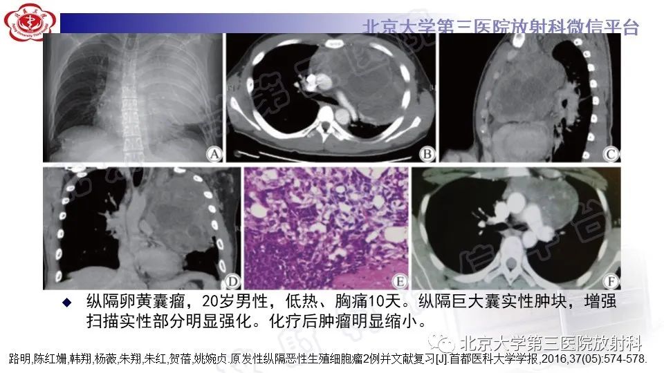 原发性纵隔胚胎性癌-33