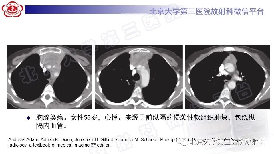 原发性纵隔胚胎性癌-37