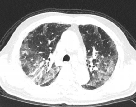 如何在影像上判断新冠病毒肺部感染是否好转