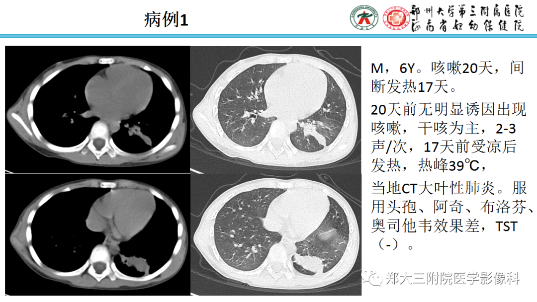 肺实变与肺不张的CT鉴别诊断-2