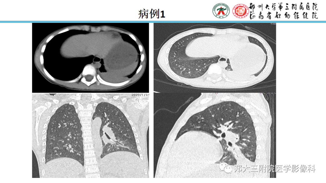 肺实变与肺不张的CT鉴别诊断-3