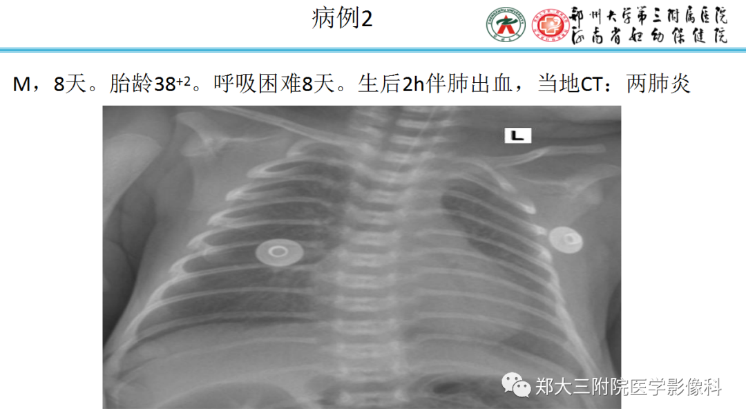 肺实变与肺不张的CT鉴别诊断-10