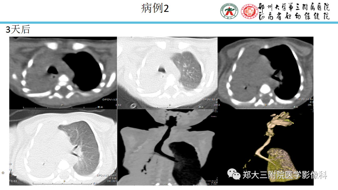 肺实变与肺不张的CT鉴别诊断-11