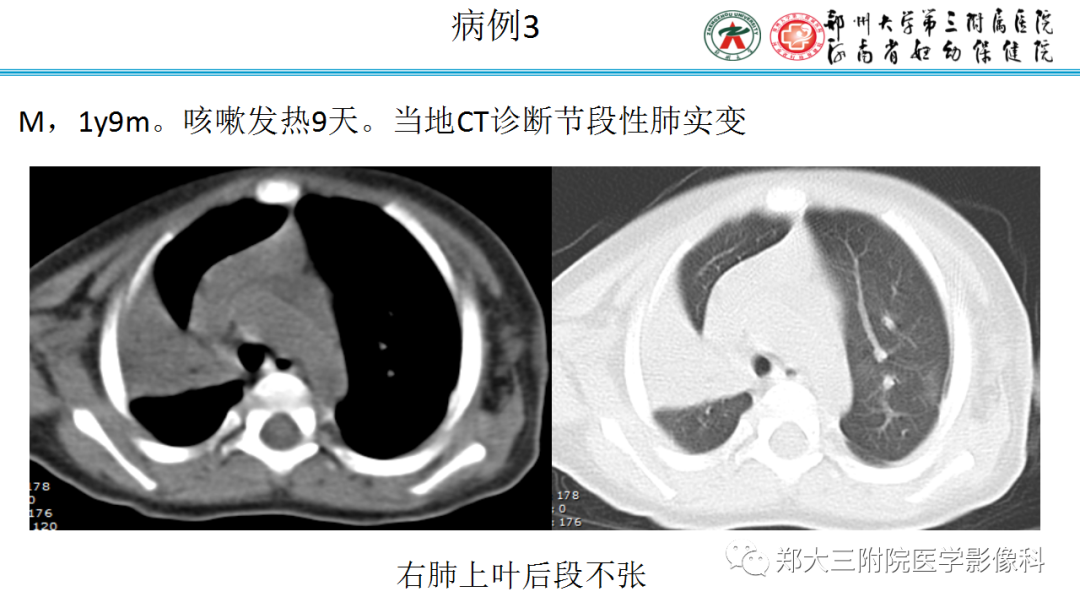 肺实变与肺不张的CT鉴别诊断-12