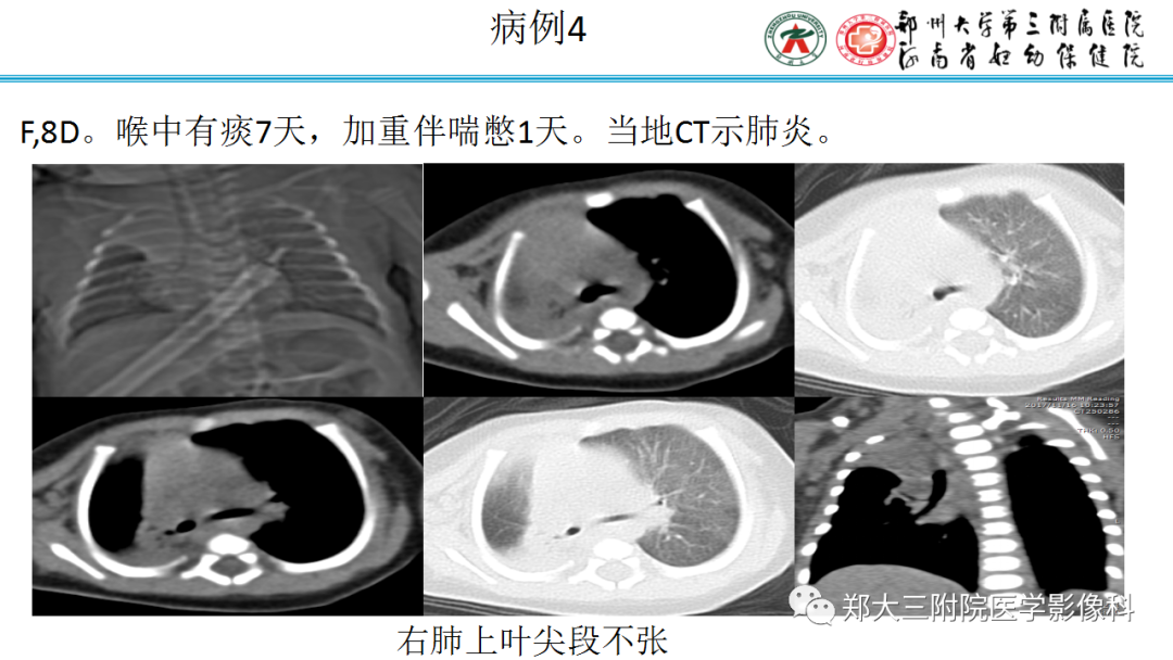 肺实变与肺不张的CT鉴别诊断-13