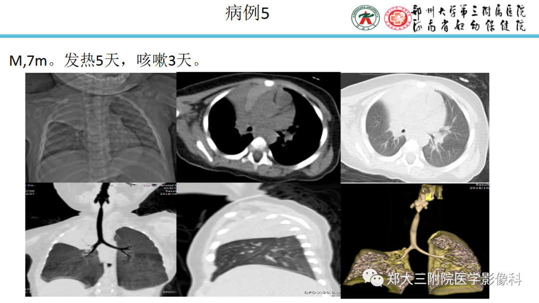 肺实变与肺不张的CT鉴别诊断-14