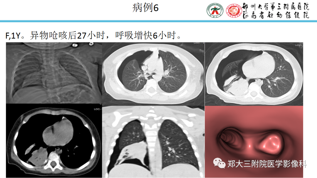 肺实变与肺不张的CT鉴别诊断-15