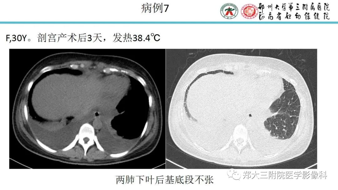 肺实变与肺不张的CT鉴别诊断-17