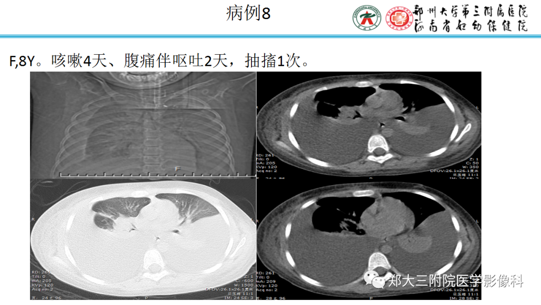 肺实变与肺不张的CT鉴别诊断-18