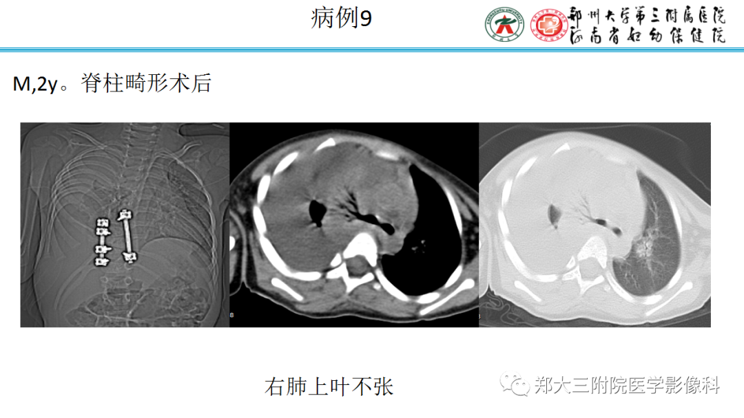 肺实变与肺不张的CT鉴别诊断-19