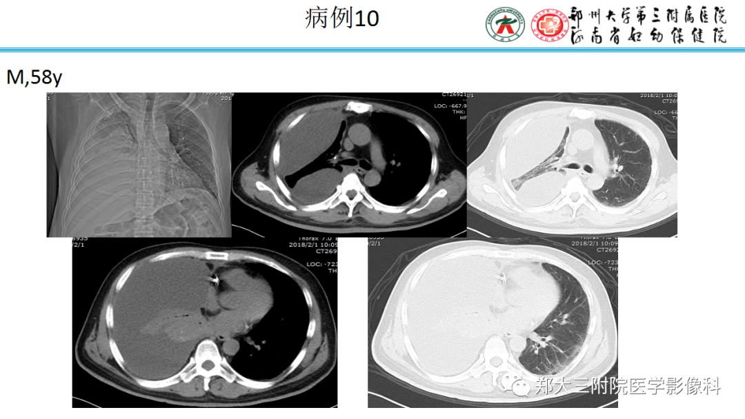 肺实变与肺不张的CT鉴别诊断-20