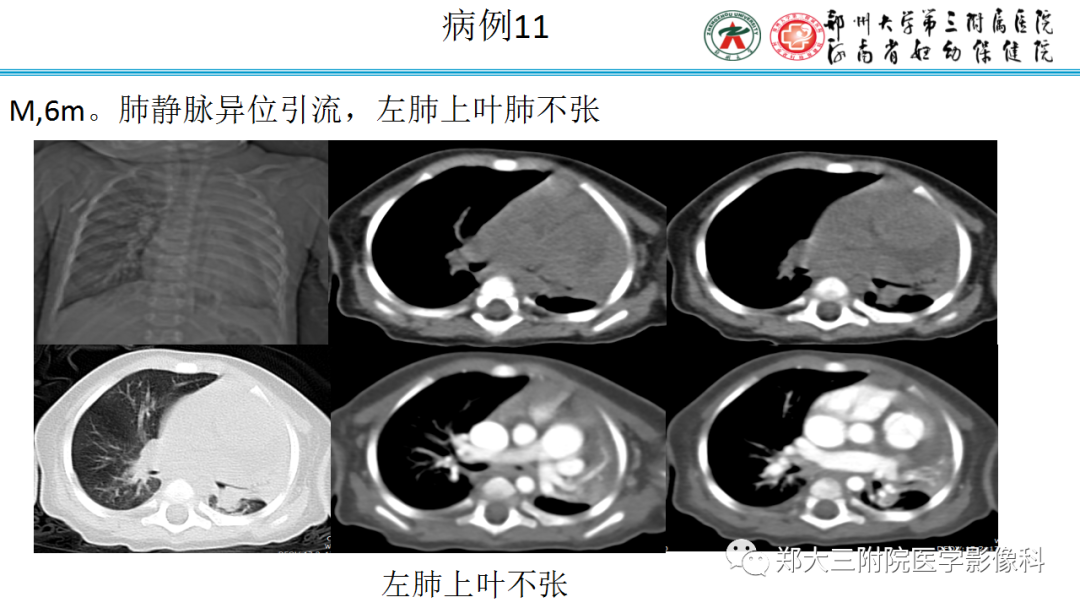 肺实变与肺不张的CT鉴别诊断-21