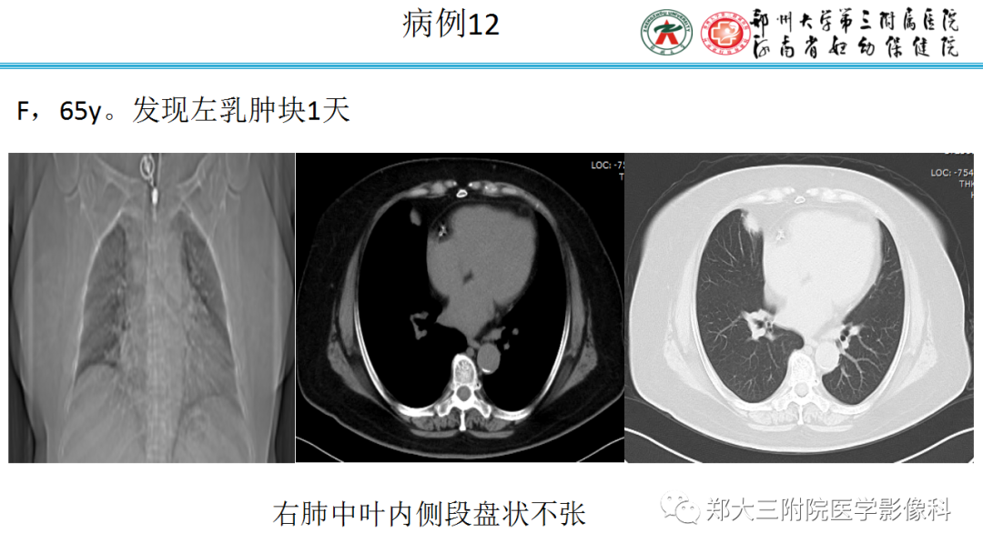 肺实变与肺不张的CT鉴别诊断-23