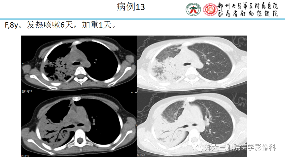 肺实变与肺不张的CT鉴别诊断-28