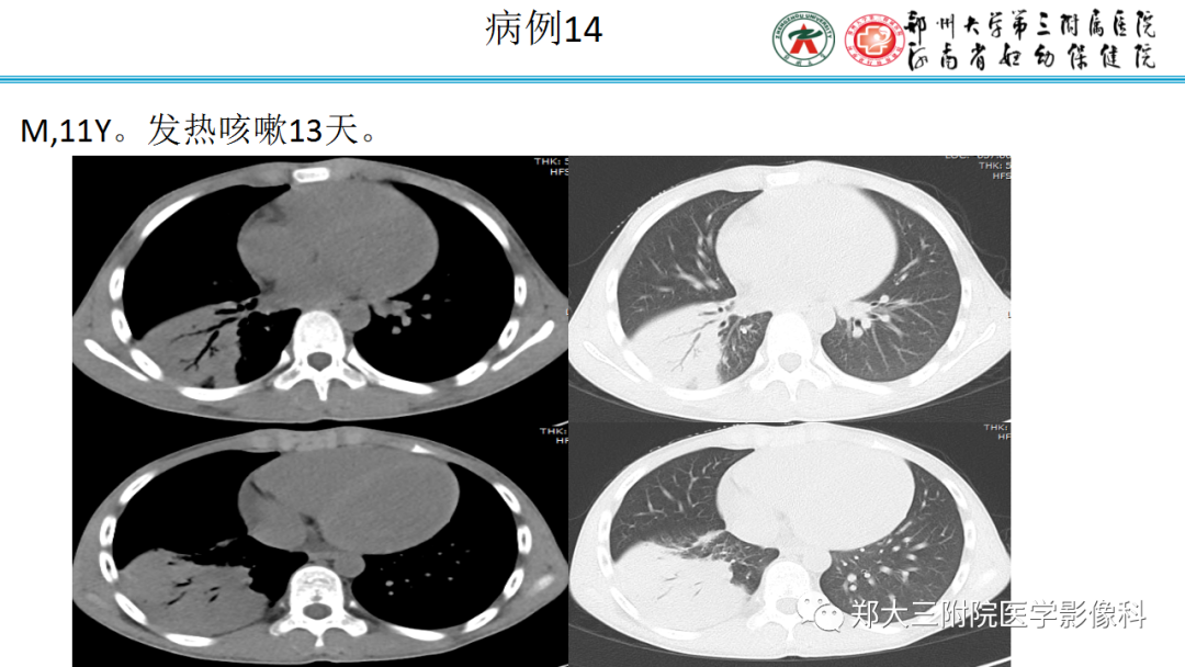 肺实变与肺不张的CT鉴别诊断-29