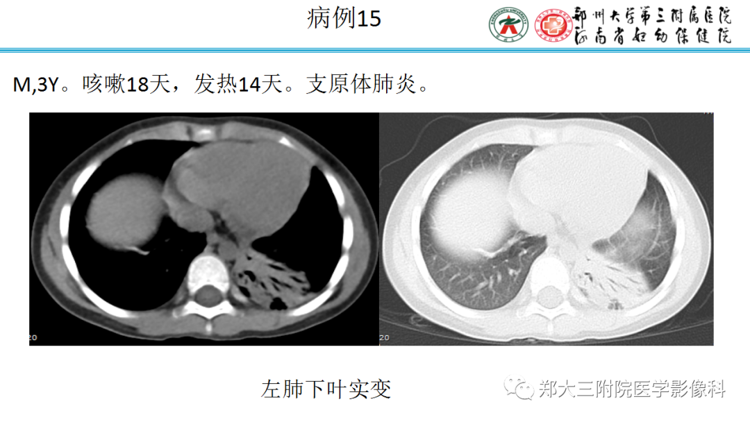 肺实变与肺不张的CT鉴别诊断-30