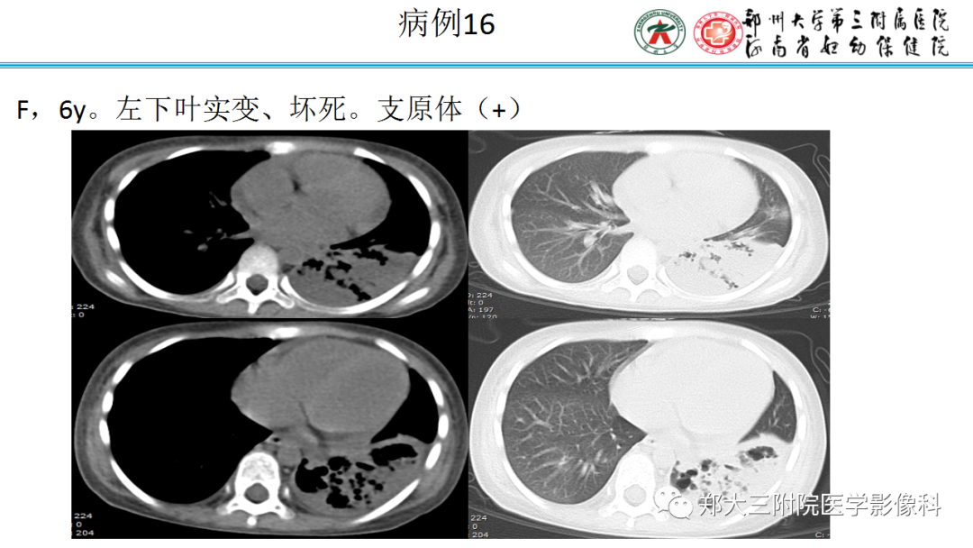 肺实变与肺不张的CT鉴别诊断-31