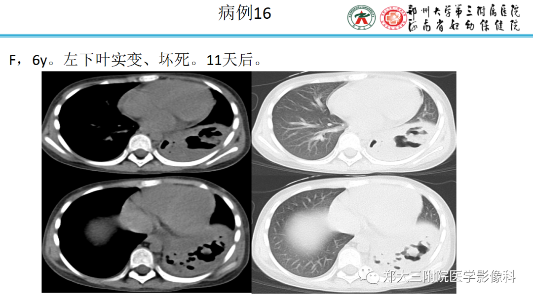 肺实变与肺不张的CT鉴别诊断-32