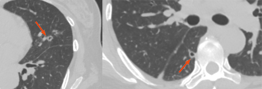 肺转移瘤的十种不典型CT表现
