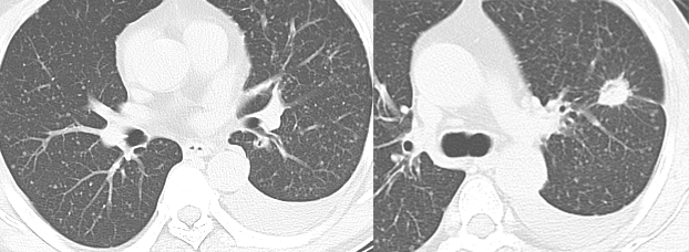 肺转移瘤的十种不典型CT表现