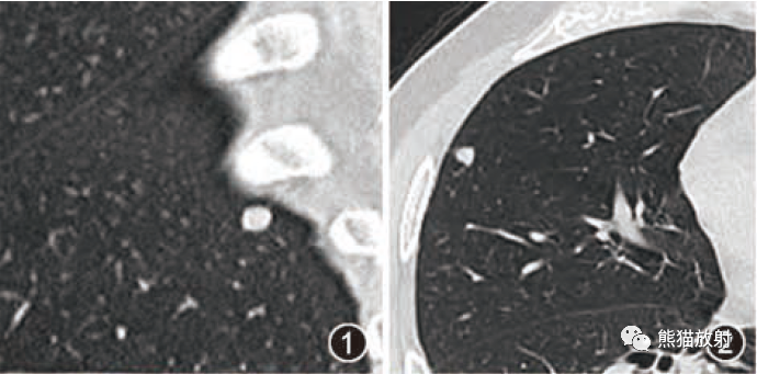 肺内淋巴结的CT表现特点及与病理对照