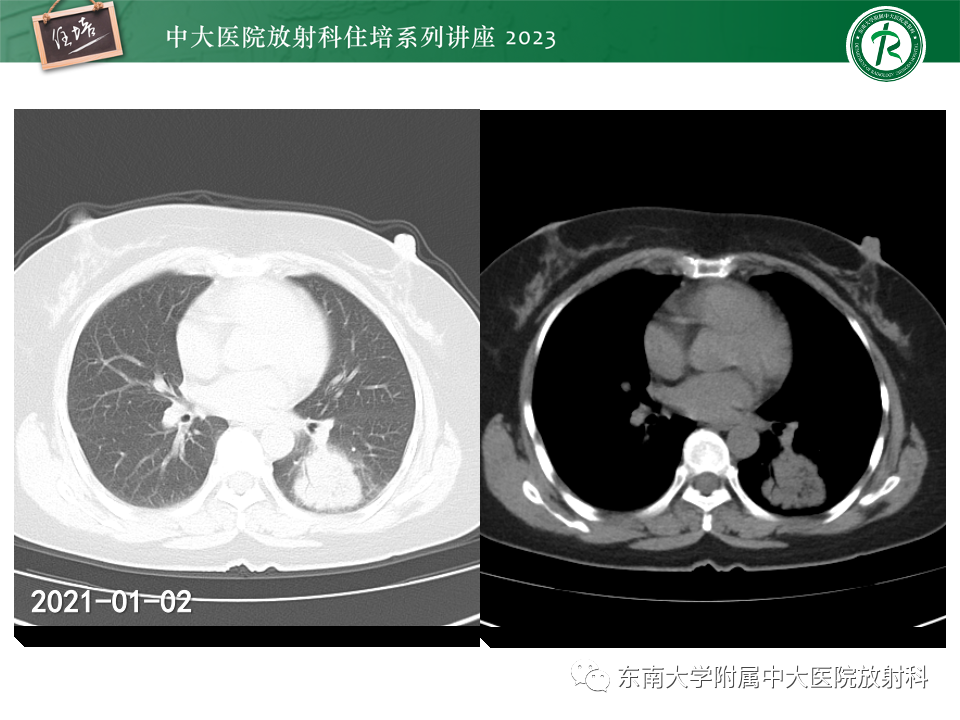 肺部特殊感染影像分析-3