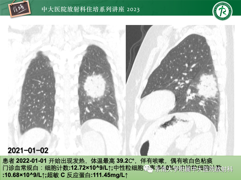 肺部特殊感染影像分析-4