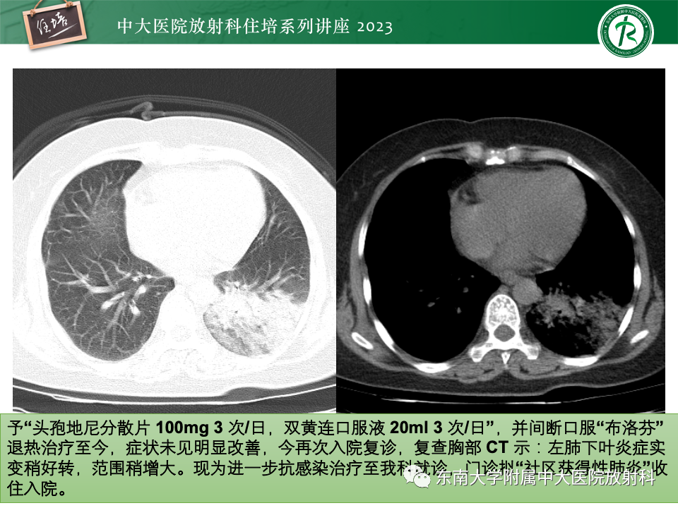 肺部特殊感染影像分析-5