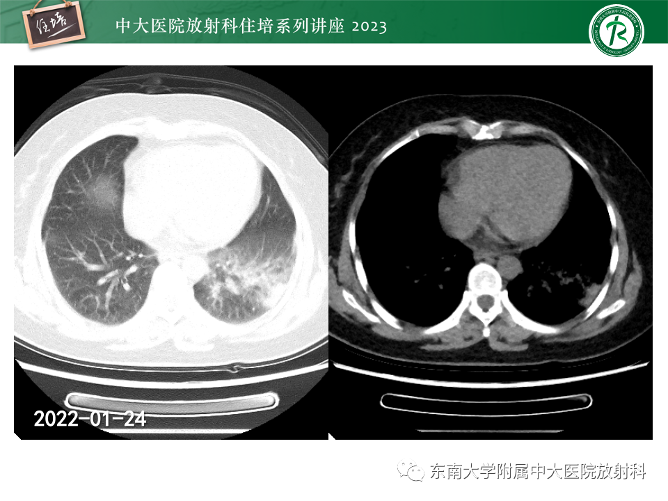 肺部特殊感染影像分析-8