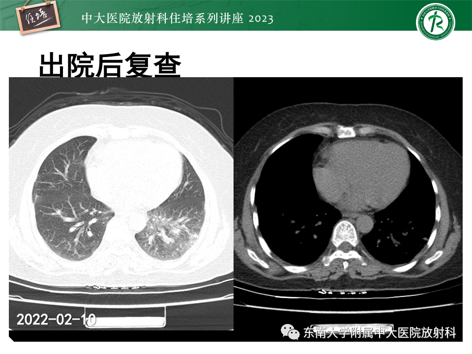 肺部特殊感染影像分析-9