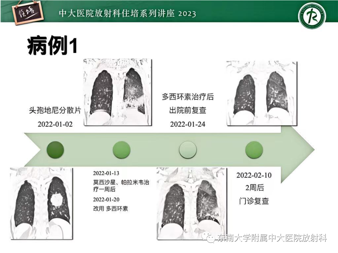 肺部特殊感染影像分析-13