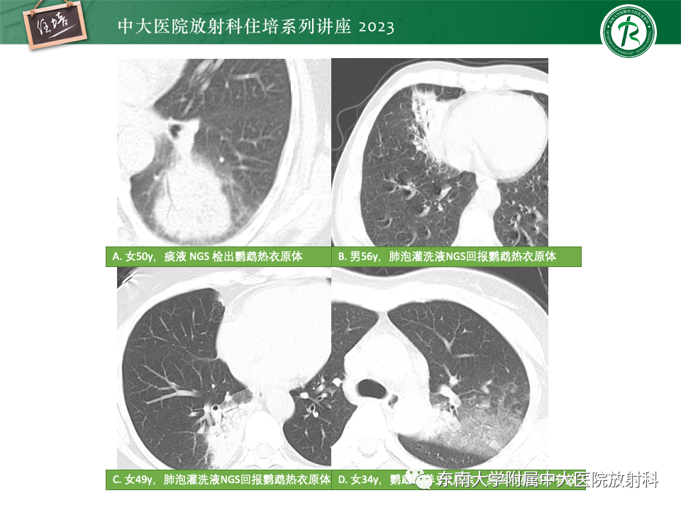 肺部特殊感染影像分析-24