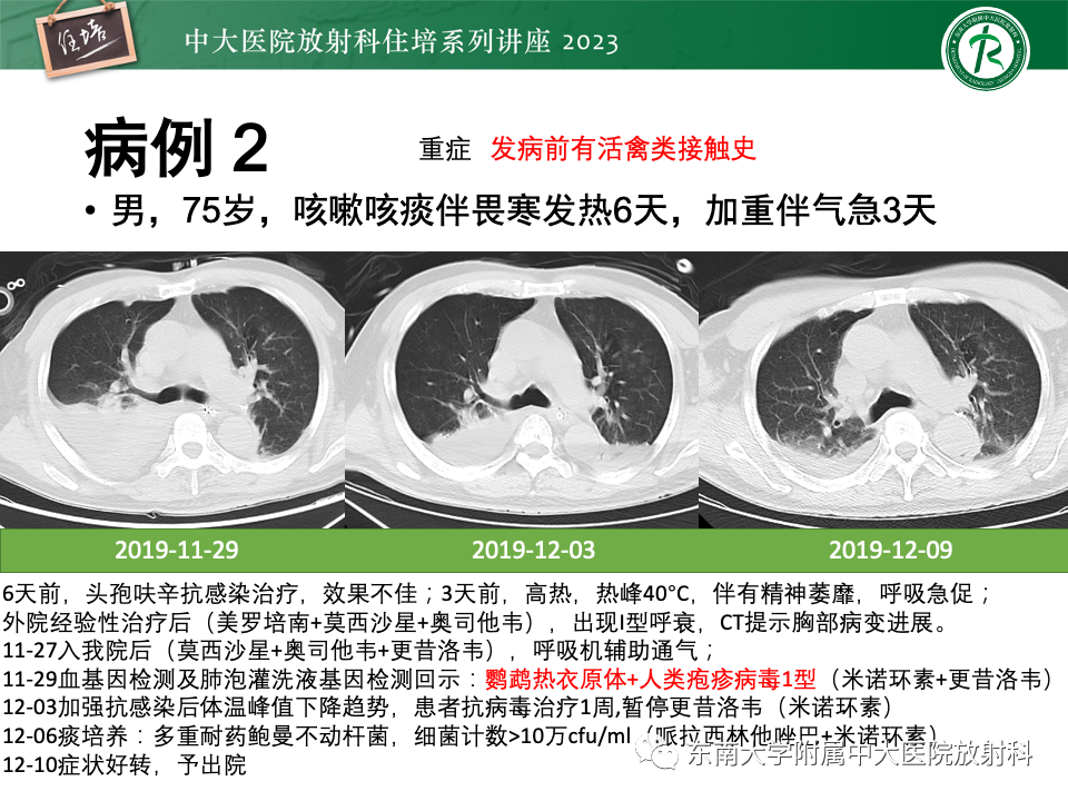 肺部特殊感染影像分析-25